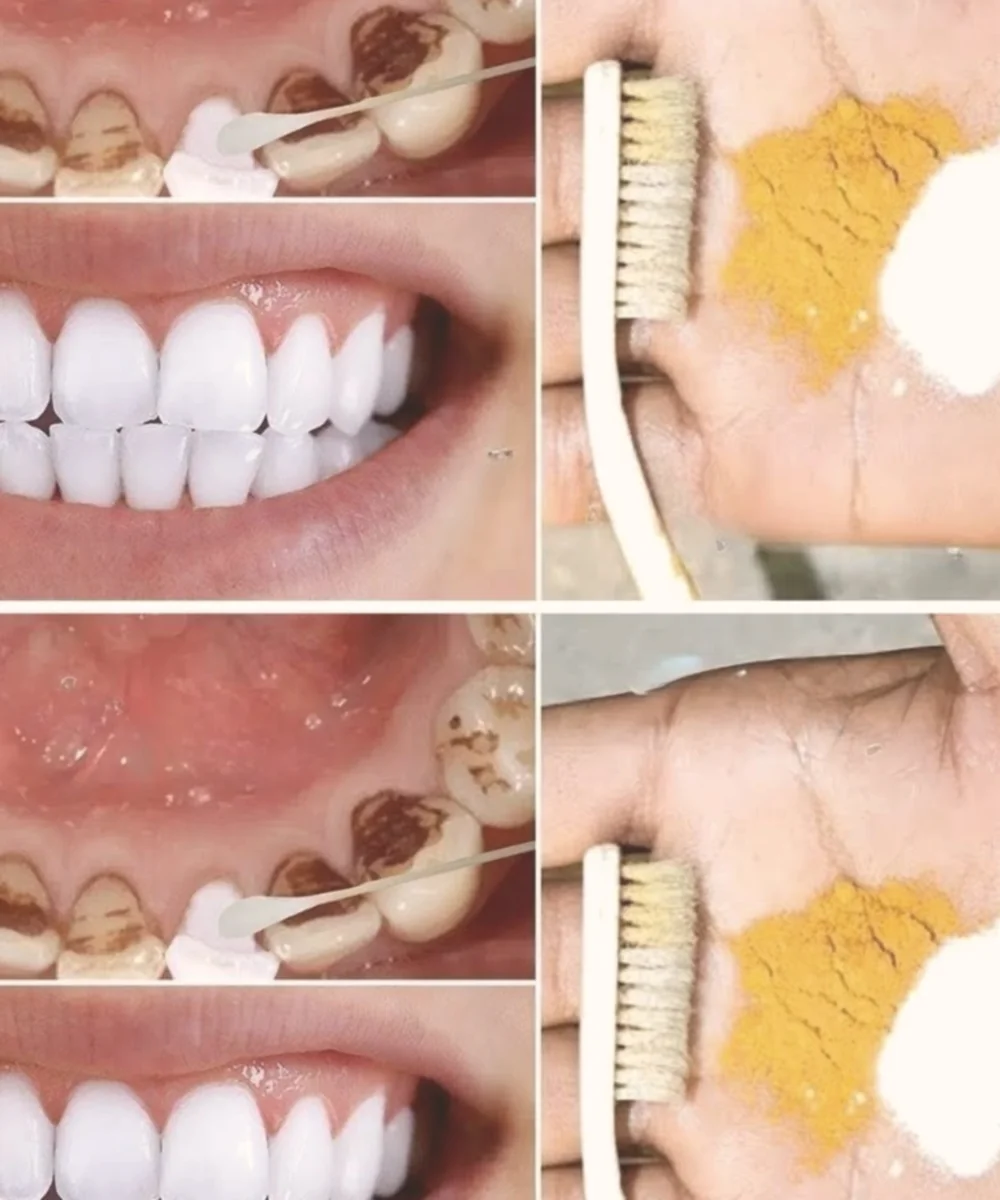 Home Teeth Whitening: Get Whiter Teeth in Just 2 Minutes!