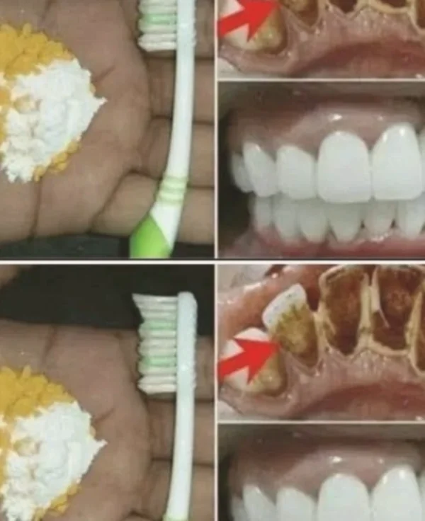 Home Teeth Whitening: What Actually Works