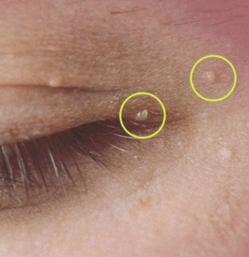 How to Get Rid of Milia: Those Annoying Fat Cysts